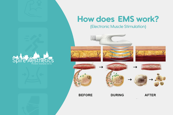 EMS treatment for post pregnancy weight loss treatment Nottingham