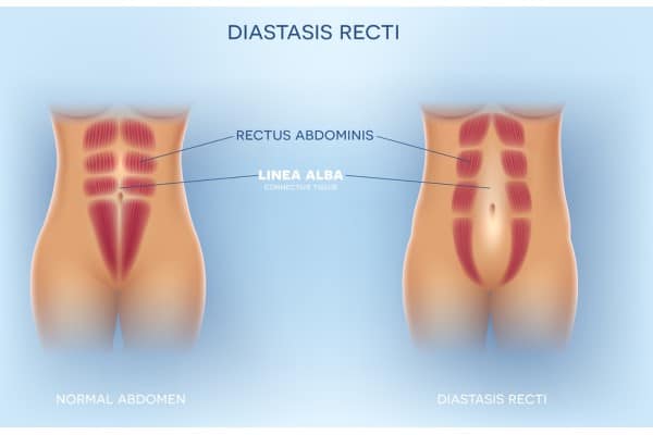 What Non-Surgical Options Are Available for Diastasis Recti Nottingham?