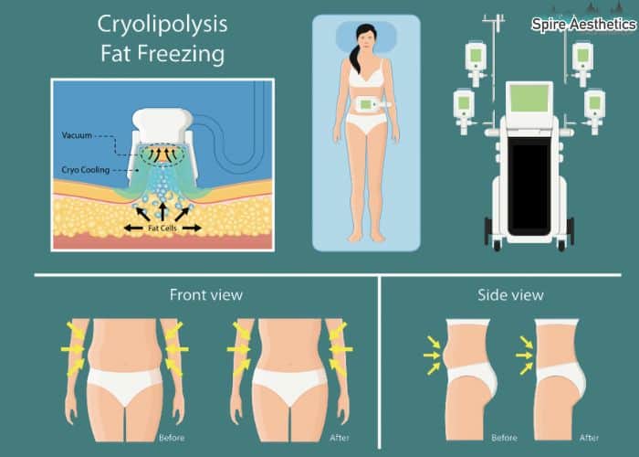 Image of diet and fat freezing combined for best results for Spire Aesthetics Nottingham