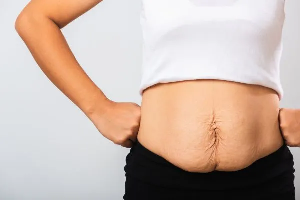 Image of a woman's stomach after weight loss with sagging skin following a gastric band Nottingham