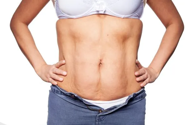 sagging skin on woman's stomach after weight loss injections Nottingham