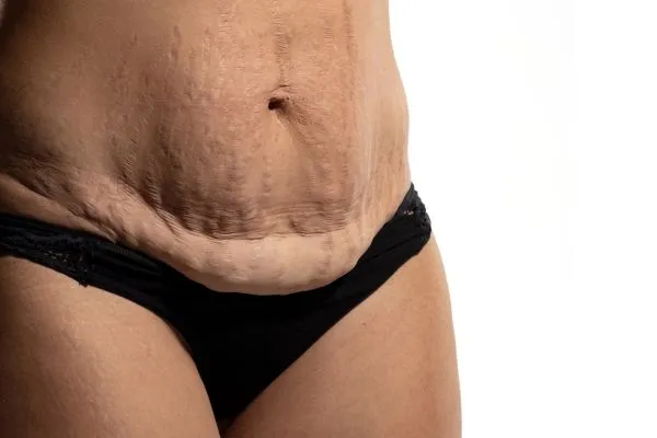 Image of womans stomach after weight loss injections Nottingham showing saggy skin