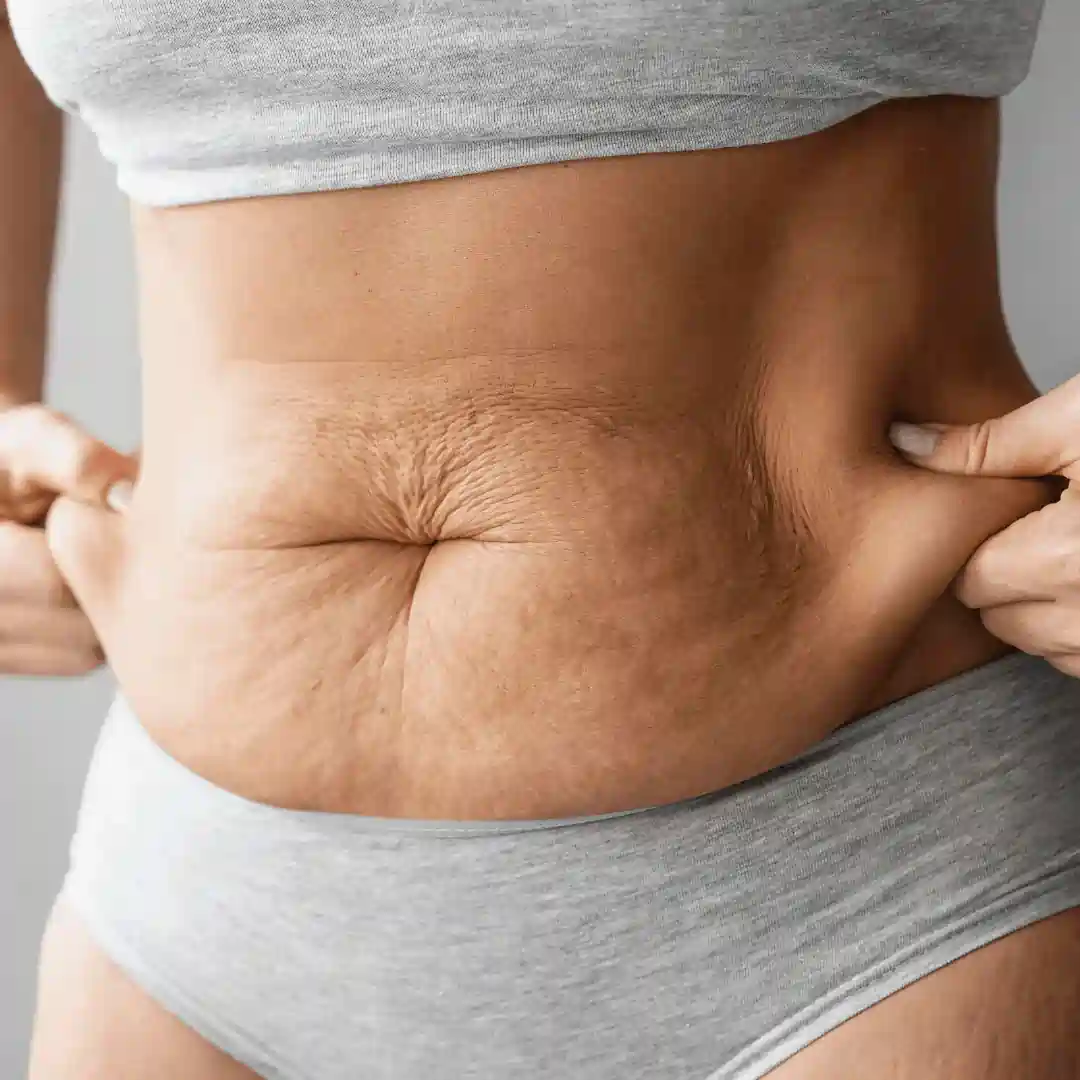 Is It Normal to Have Loose Skin After Pregnancy Nottingham?