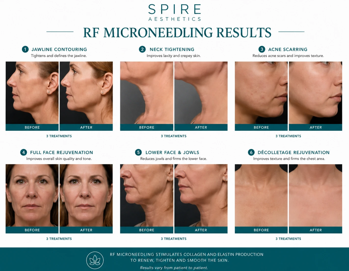 RF Microneedling Skin tightening Nottingham results