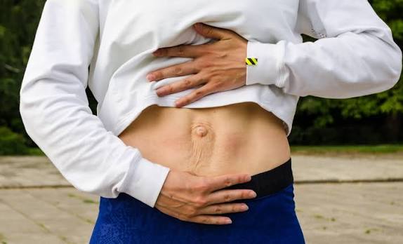 When Could Diastasis Recti Be the Missing Piece of the Puzzle Nottingham?