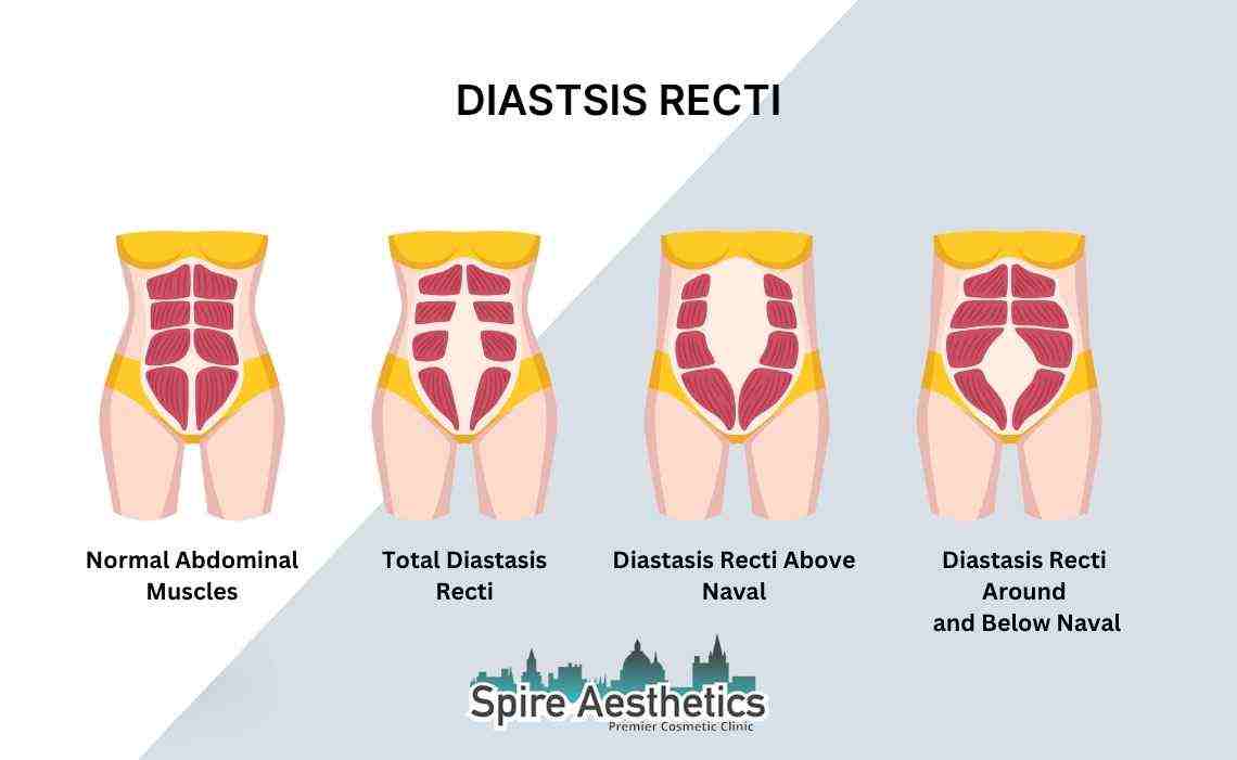 Is Non-Surgical Diastasis Recti Treatment Right for You? Common Concerns Answered Nottingham